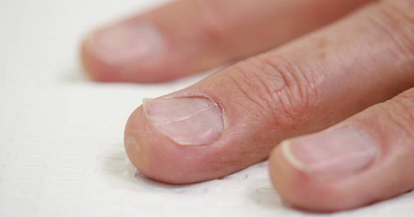 Unhas encravadas - porque é que surgem? Diagnóstico e tratamento