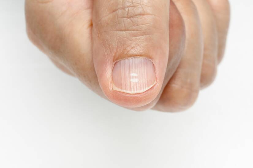 Linhas inestéticas nas unhas: porque é que surgem e podem ser evitadas?
