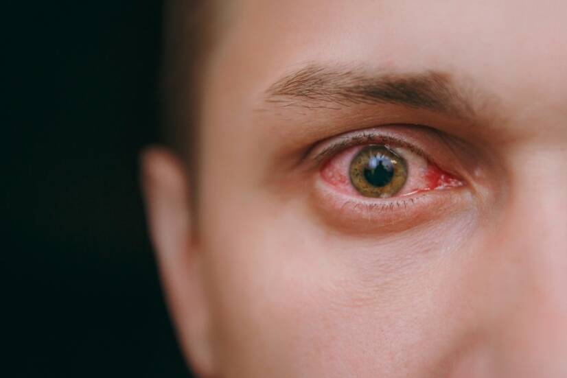 Vermelhidão conjuntival: quais são as causas (+ sintomas)
