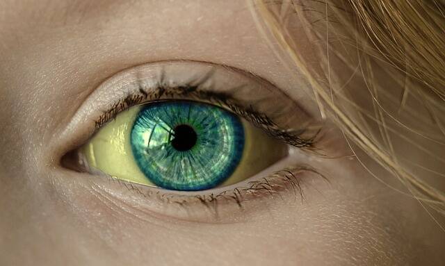 O que pode causar o branco dos olhos amarelo?