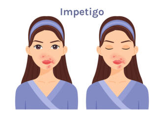 O que é o impetigo, que sintomas apresenta? Infecciosidade e transmissão nas crianças