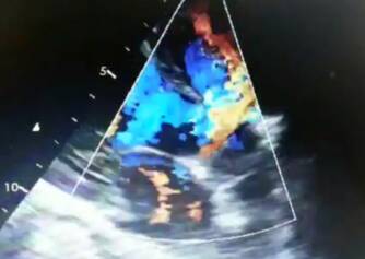Defeito septal dos ventrículos