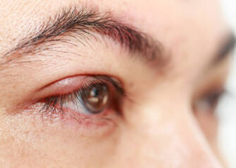 Grão de cevada no olho: porque é que se forma, como é que se trata (Hordeolum + chalazion)