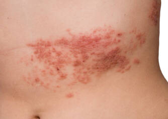 Herpes zóster: transmissão, sintomas, tratamento e complicações do herpes zóster?