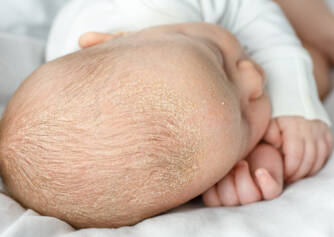 O que é a dermatite seborreica? Quais são os sintomas, as causas? + Distribuição