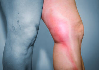 Tromboflebite das veias superficiais: o que é a flebite e porque é que ocorre?