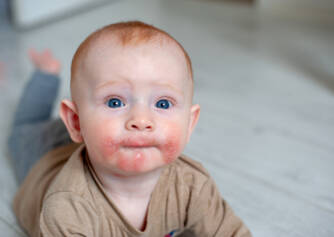 Eczema atópico - o seu filho também sofre com isso?
