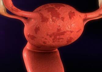 Como é que a endometriose e a infertilidade estão relacionadas + Outros sintomas e problemas de saúde