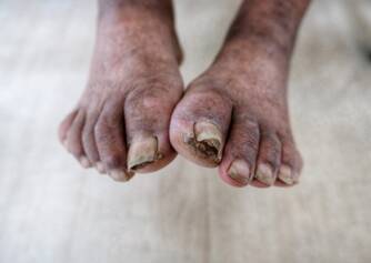 O que é a gangrena, quais são os seus sintomas e tratamento?