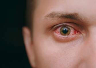 Vermelhidão conjuntival: quais são as causas (+ sintomas)