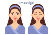 O que é o impetigo, que sintomas apresenta? Infecciosidade e transmissão nas crianças