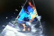 Defeito septal dos ventrículos