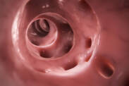 Diverticulose e diverticulite: quais são as causas e os sintomas? + Tratamento