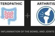 Artrite enteropática e doença inflamatória intestinal: como se relacionam + Sintomas