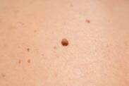 O que é um fibroma na pele, qual o seu aspeto e que sintomas apresenta?
