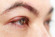 Grão de cevada no olho: porque é que se forma, como é que se trata (Hordeolum + chalazion)
