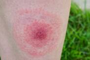 Doença de Lyme: como se transmite e como se manifesta + Tratamento