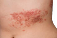 Herpes zóster: transmissão, sintomas, tratamento e complicações do herpes zóster?