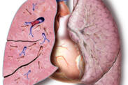 Embolia pulmonar: porque ocorre, como se manifesta, como é detectada e tratada?