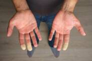 Síndrome de Raynaud: qual é a causa da dormência dos dedos?