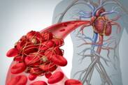 Doença tromboembólica, porque é que ocorre, qual a sua relação com a embolia pulmonar?