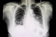 Como é que a pneumonia se manifesta e qual é o tratamento mais eficaz?