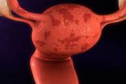 Como é que a endometriose e a infertilidade estão relacionadas + Outros sintomas e problemas de saúde