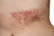 Porque é que o herpes-zóster ocorre e qual é o tratamento mais eficaz?