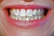 Manchas brancas nos dentes e as suas causas? Como ajudar-se a si próprio e remover as manchas?