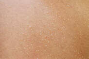 Pele húmida devido a inflamação, dermatite ou eczema? Conheça as causas