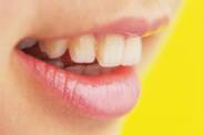 Dentes a abanar: quais são as causas (em adultos e crianças)?