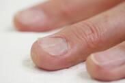 Unhas encravadas - porque é que surgem? Diagnóstico e tratamento