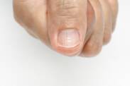 Linhas inestéticas nas unhas: porque é que surgem e podem ser evitadas?