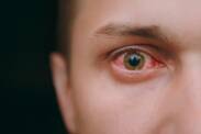 Vermelhidão conjuntival: quais são as causas (+ sintomas)